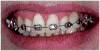 smiling with braces