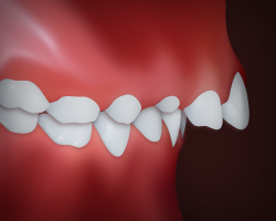 Upper Front <br>Teeth Protrusion