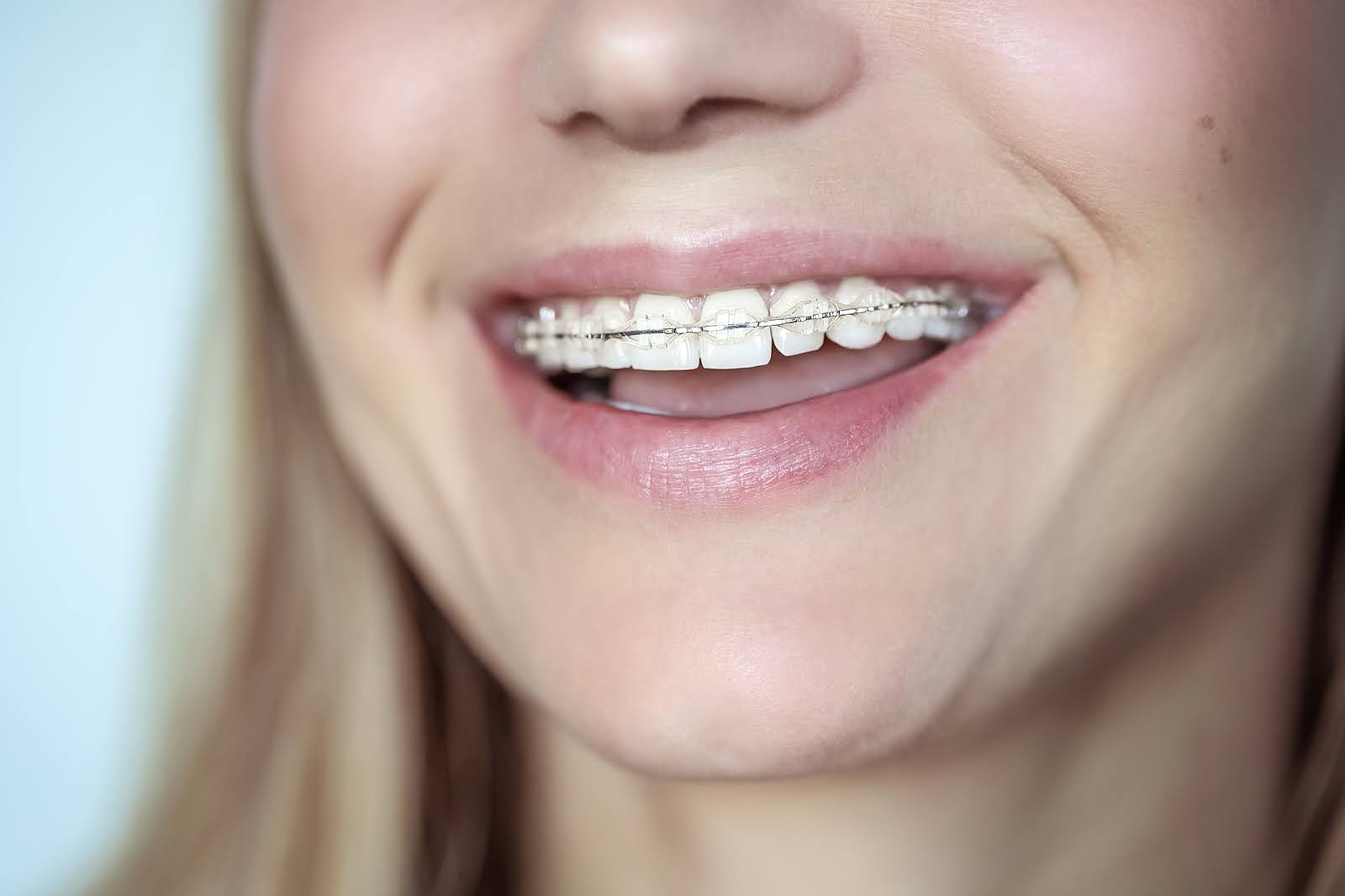 Close-up smile showing metal braces as part of adult orthodontic treatment