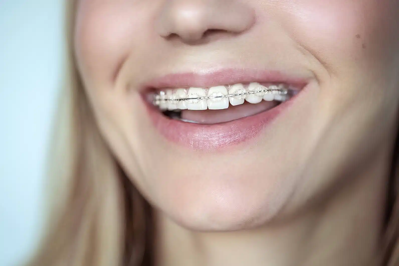 Close-up smile showing metal braces as part of adult orthodontic treatment