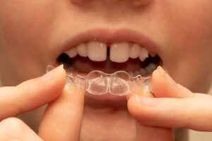 Close-up of clear aligner being held in front of teeth showing Invisalign for Adults vs Teens