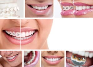 Close-up of dental braces on teeth showing alignment changes and how braces affect facial structure 