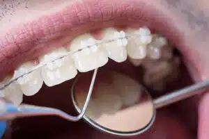 Close-up of braces and dental mirror during exam related to orthodontic consultation questions
