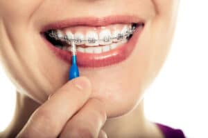 Patient cleaning braces with an interdental brush, demonstrating retainer care tips for maintaining orthodontic results