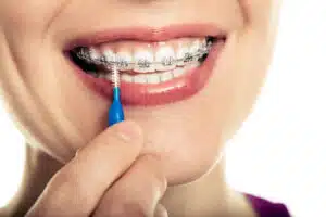 Patient cleaning braces with an interdental brush, demonstrating retainer care tips for maintaining orthodontic results