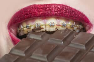 Close-up of braces biting into chocolate, illustrating foods to avoid with braces during orthodontic treatment