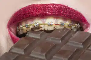 Close-up of braces biting into chocolate, illustrating foods to avoid with braces during orthodontic treatment