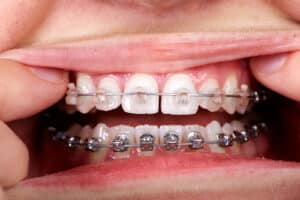 Close-up of braces with food trapped between brackets, showing braces' food restrictions and cleaning challenges 