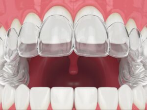 A 3D digital illustration of a dental model showing clear orthodontic aligners being fitted over the upper jaw teeth