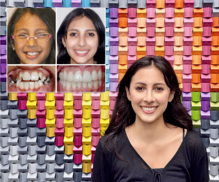 Patient smiling next to her orthodontic before and after progress photos.