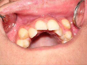 A close-up clinical view of severe teeth crowding on a patient's upper dental arch